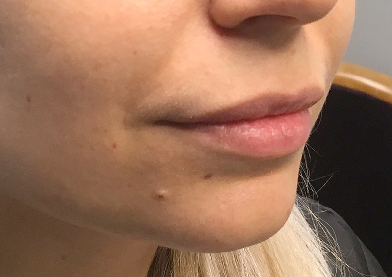 Injectables And Fillers 03