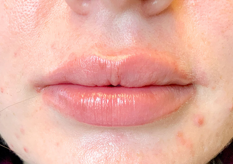 Injectables And Fillers 107