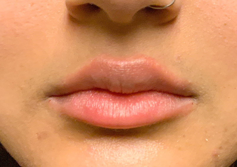 Injectables And Fillers 108