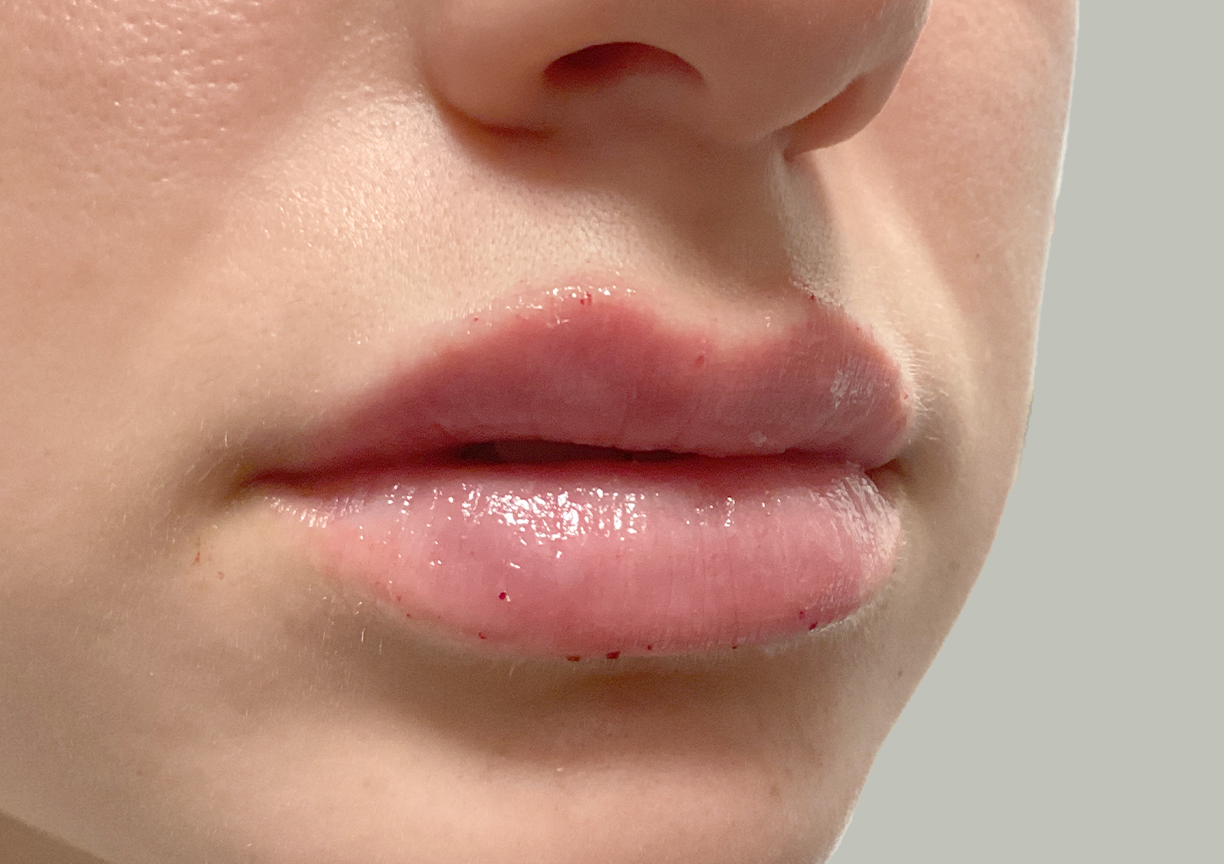 Injectables And Fillers 03