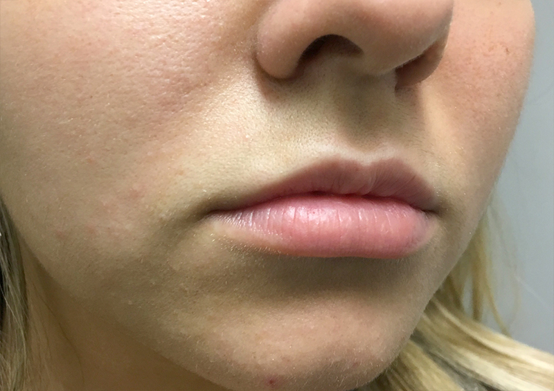 Injectables And Fillers 03