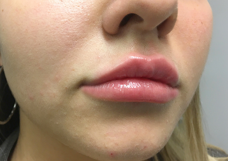 Injectables And Fillers 03