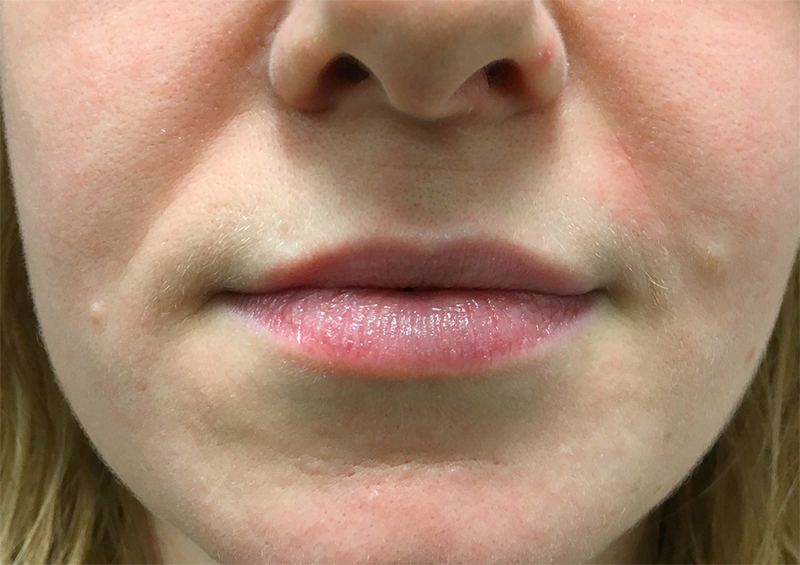 Injectables And Fillers 01