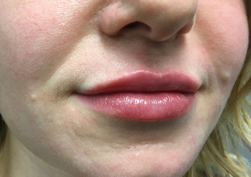 Injectables And Fillers 03