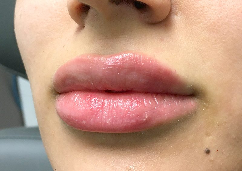 Injectables And Fillers 03