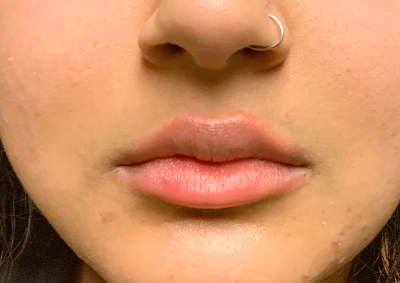 Injectables And Fillers 113