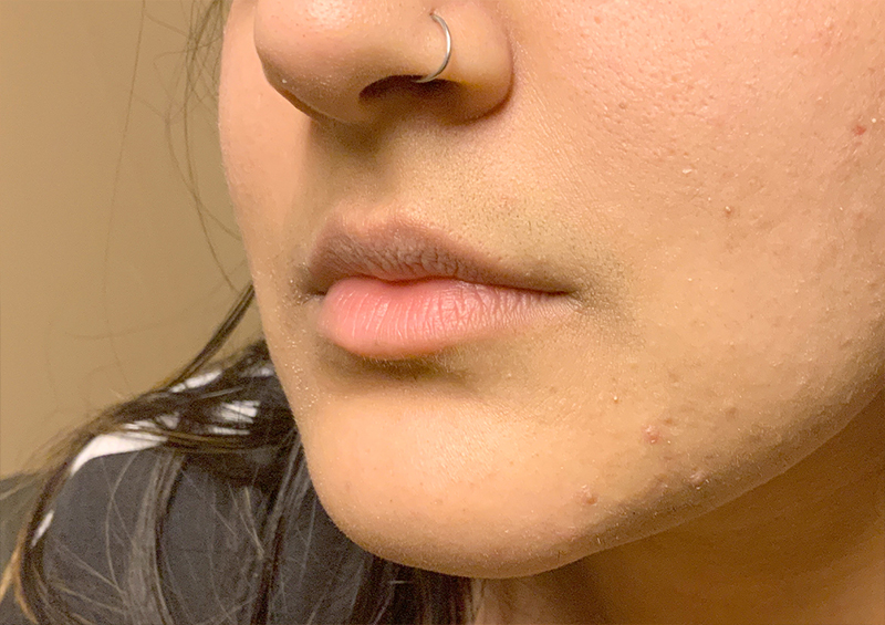 Injectables And Fillers 03