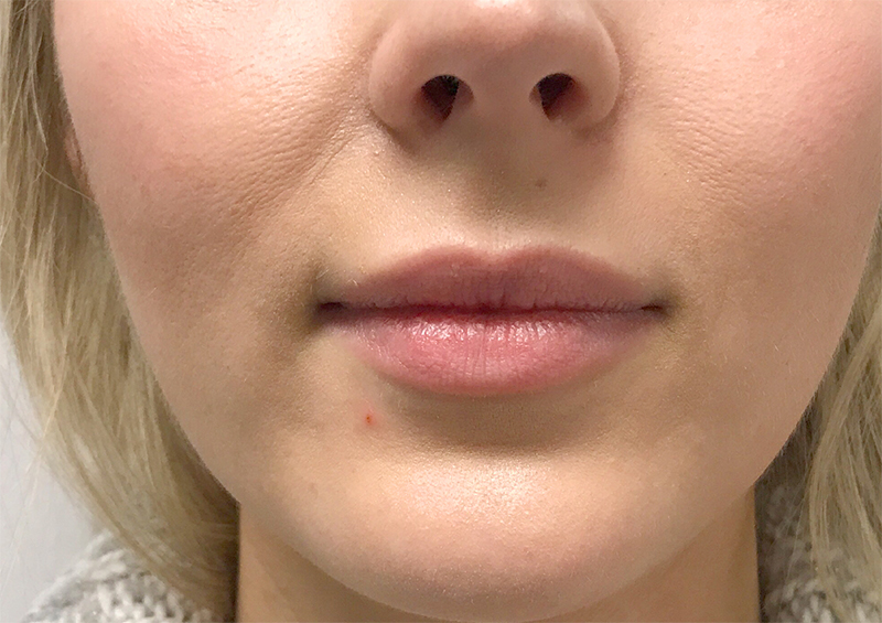 Injectables And Fillers 01