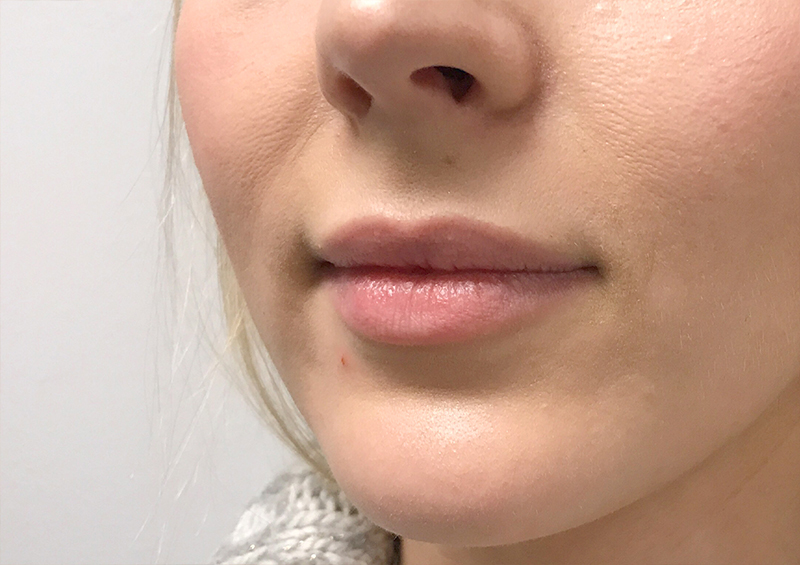 Injectables And Fillers 03