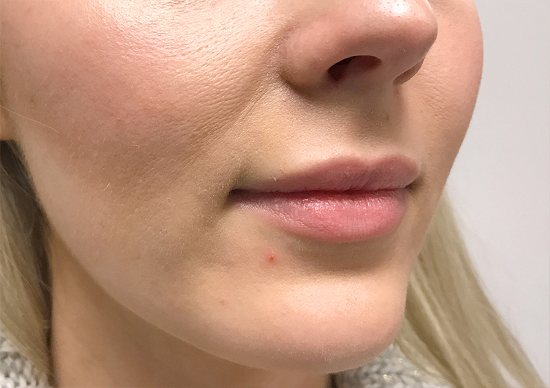 Injectables And Fillers 05