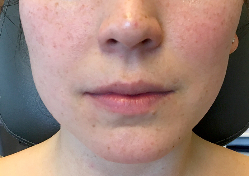 Injectables And Fillers 01