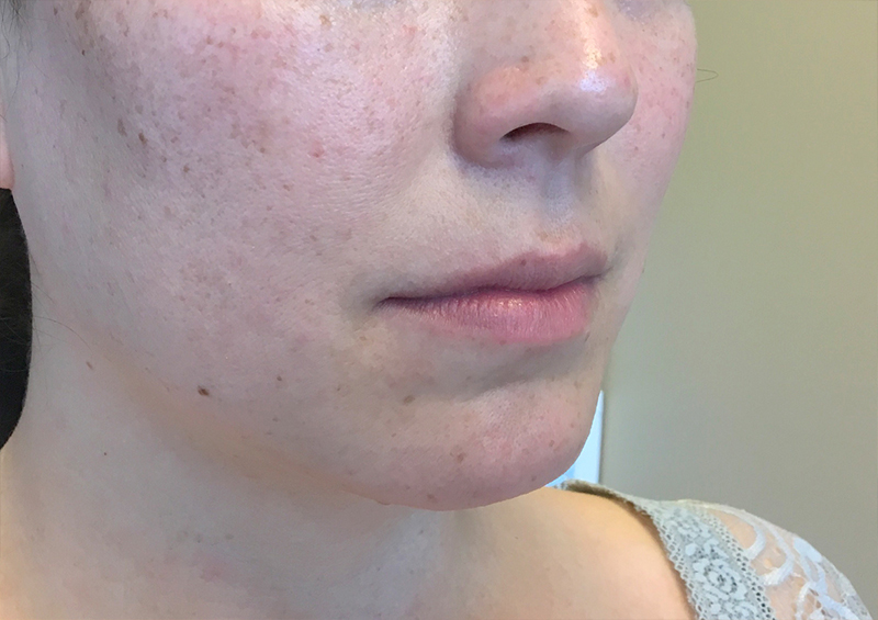 Injectables And Fillers 03