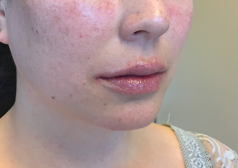 Injectables And Fillers 03