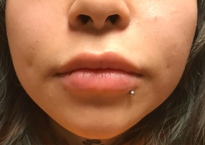 Injectables And Fillers 117