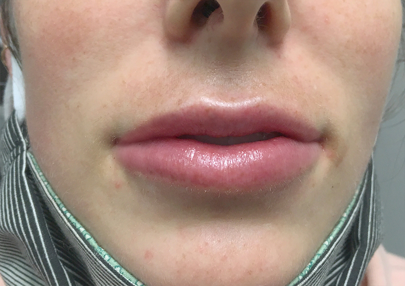 Injectables And Fillers 118