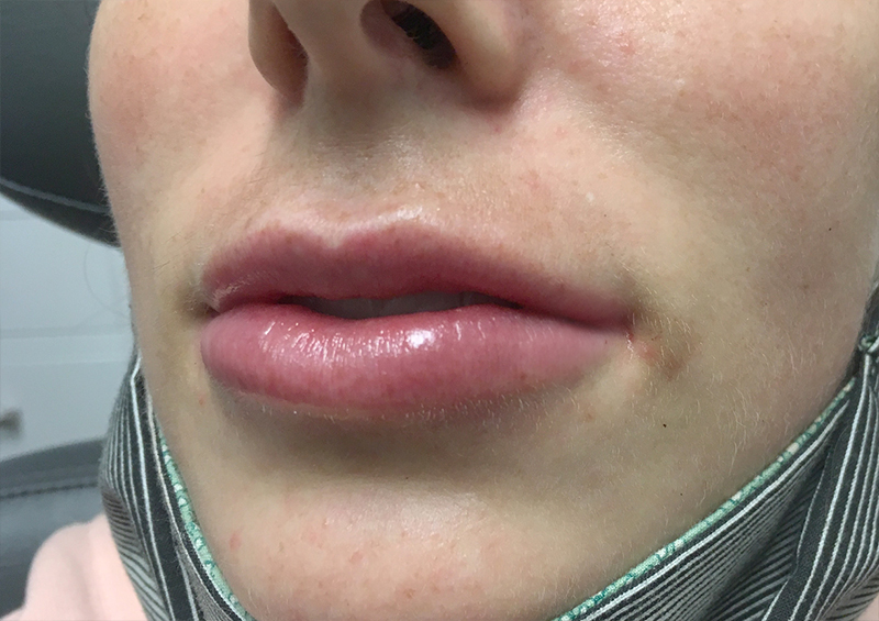 Injectables And Fillers 03