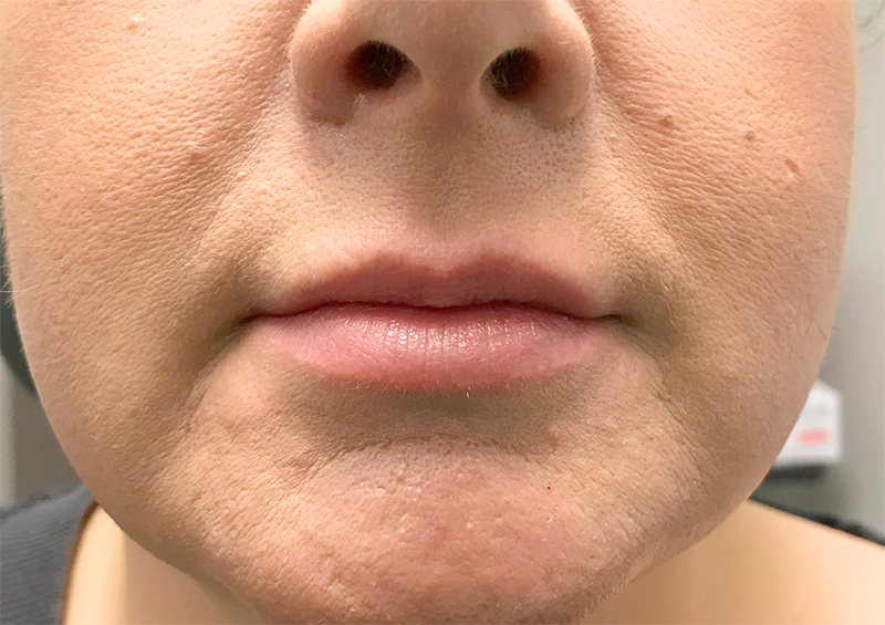 Injectables And Fillers 01