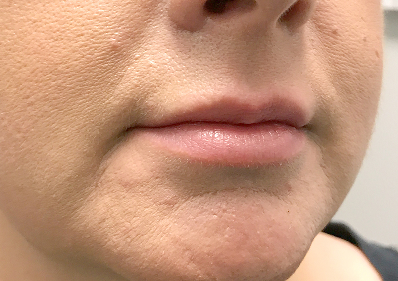 Injectables And Fillers 03