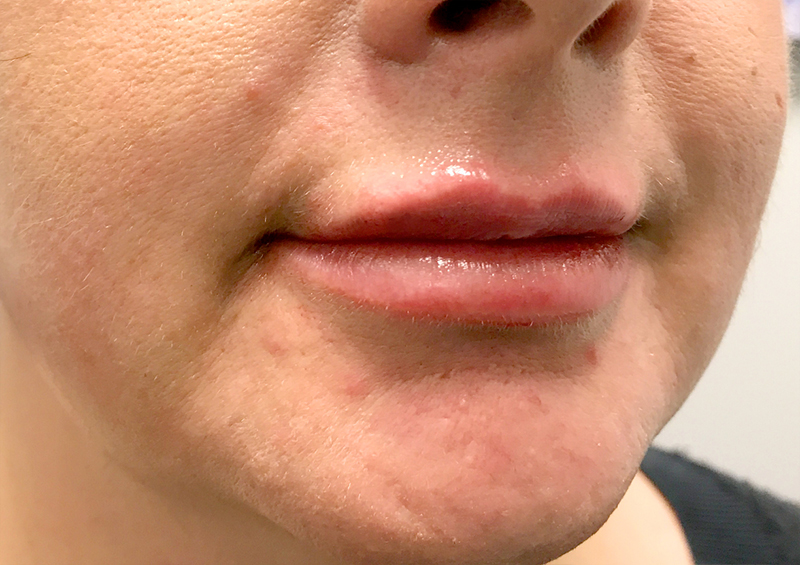 Injectables And Fillers 03