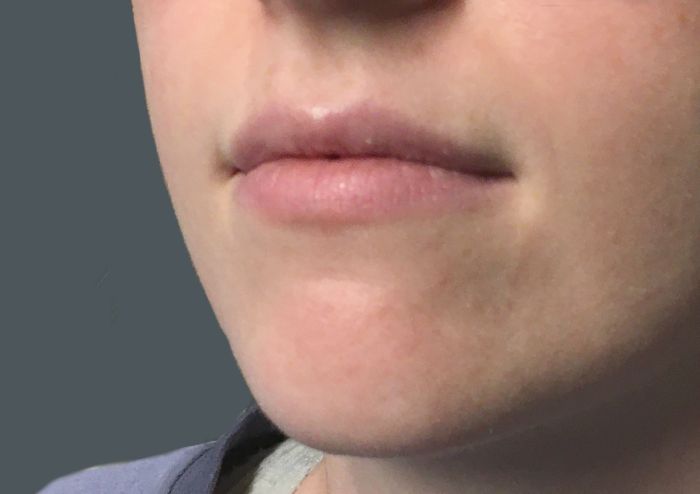 Injectables And Fillers 07