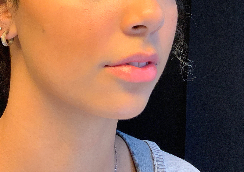 Injectables And Fillers 01