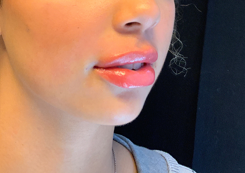 Injectables And Fillers 120