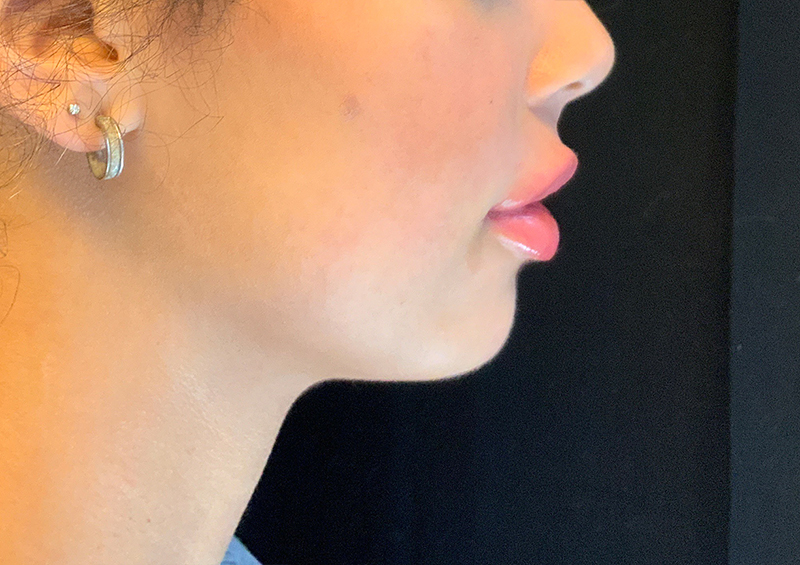 Injectables And Fillers 03