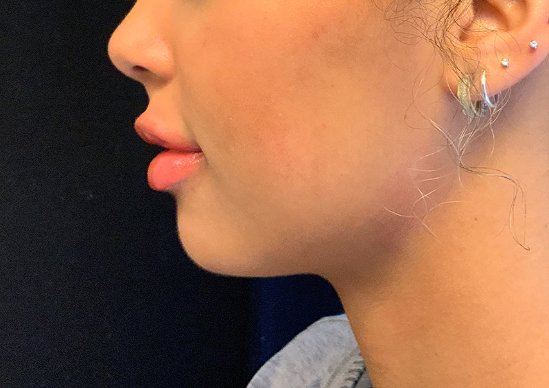 Injectables And Fillers 05