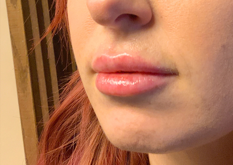 Injectables And Fillers 03