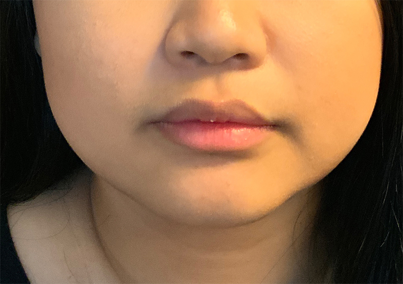 Injectables And Fillers 01