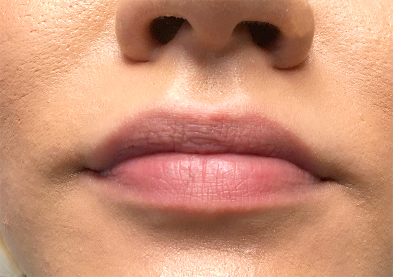 Injectables And Fillers 01