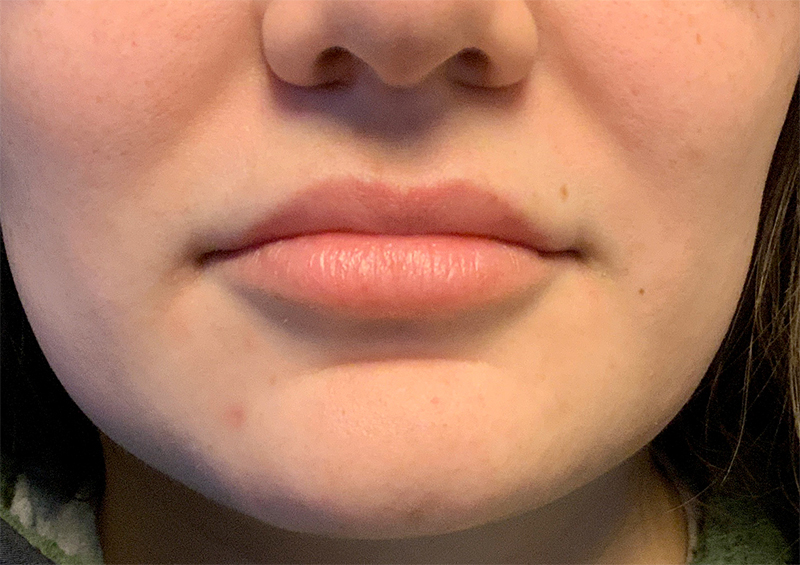 Injectables And Fillers 01