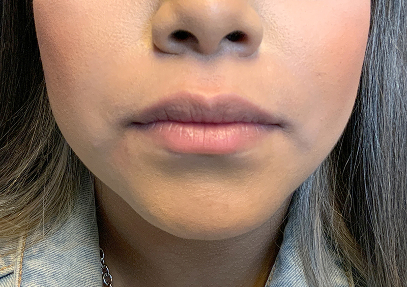 Injectables And Fillers 01