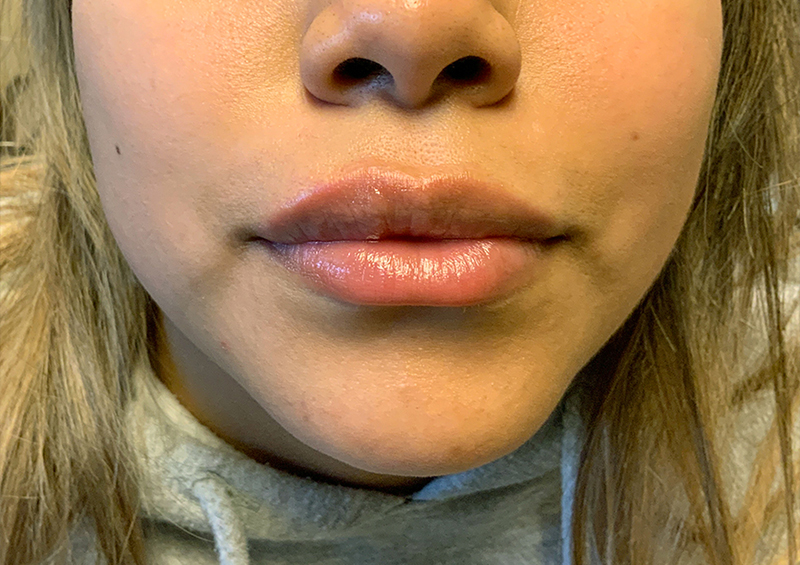 Injectables And Fillers 125