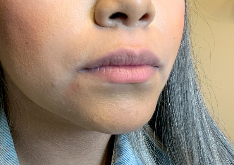 Injectables And Fillers 03