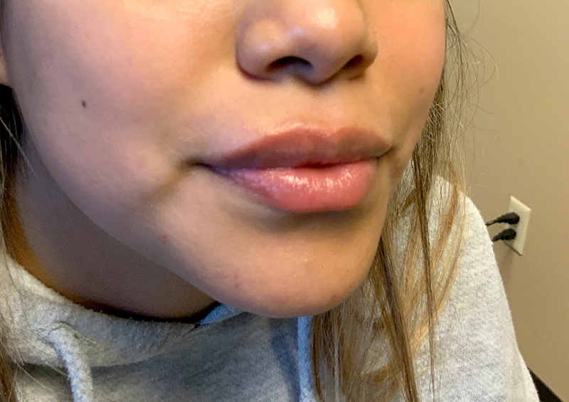 Injectables And Fillers 03