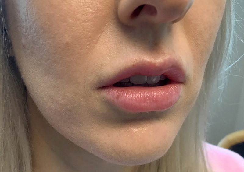 Injectables And Fillers 03