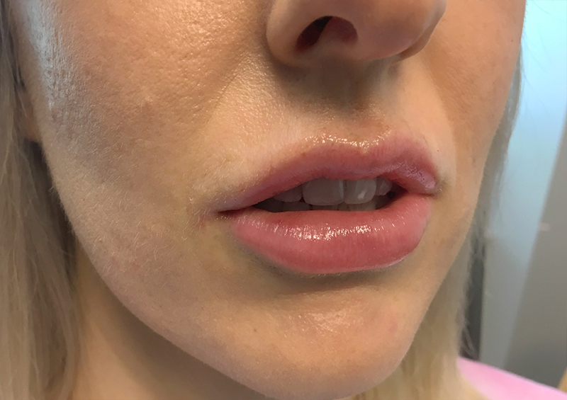 Injectables And Fillers 03