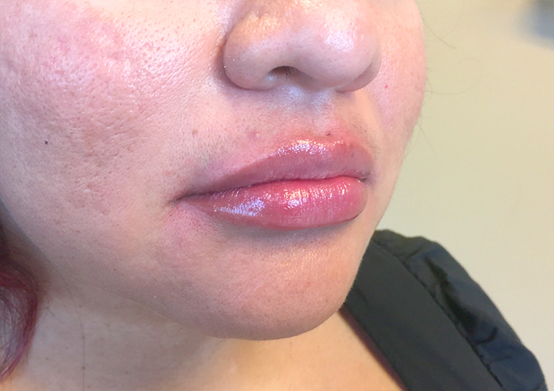 Injectables And Fillers 03