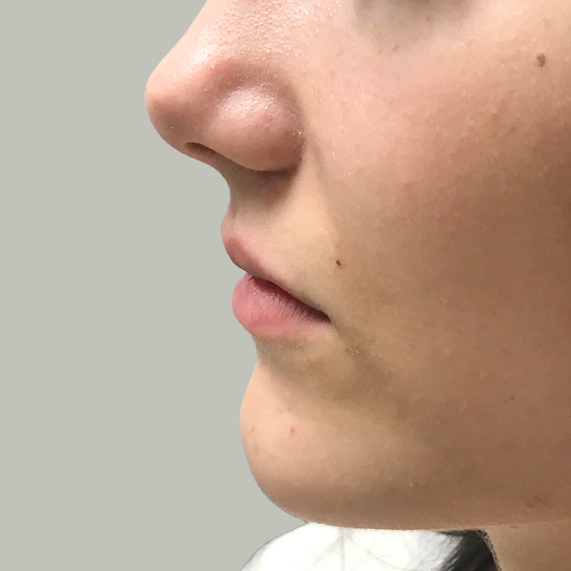 Injectables And Fillers 05