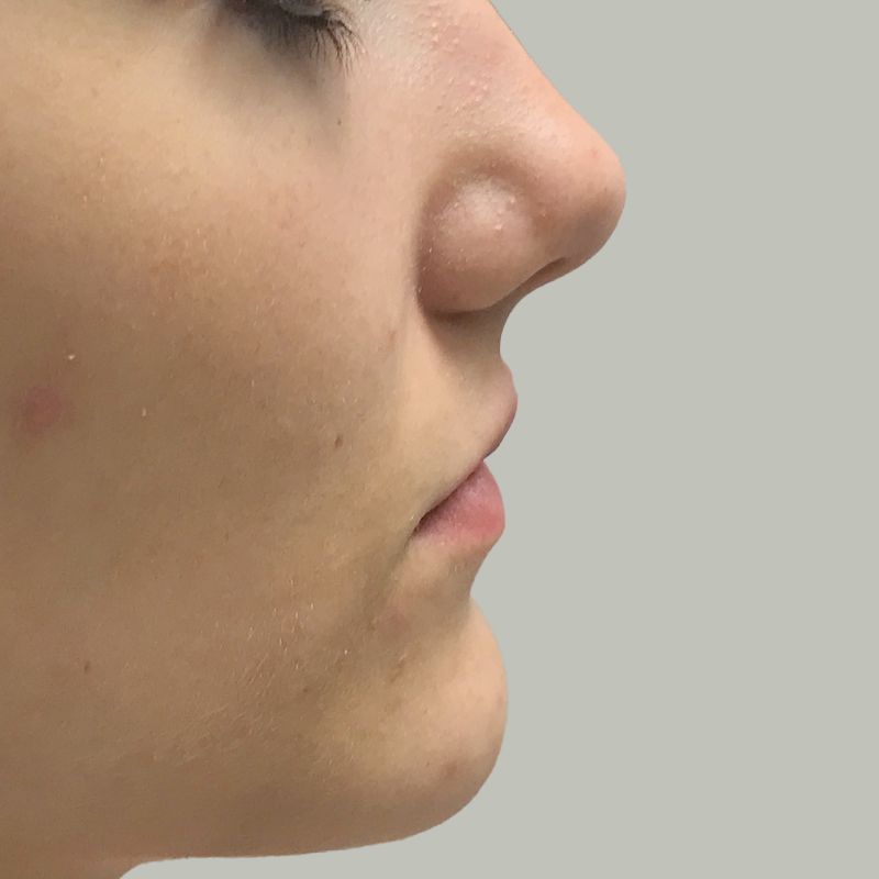 Injectables And Fillers 09