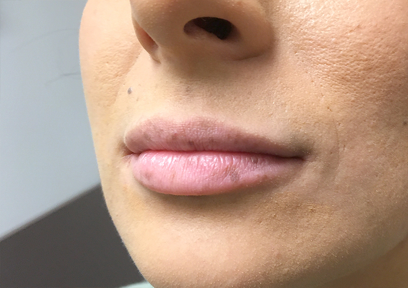 Injectables And Fillers 03