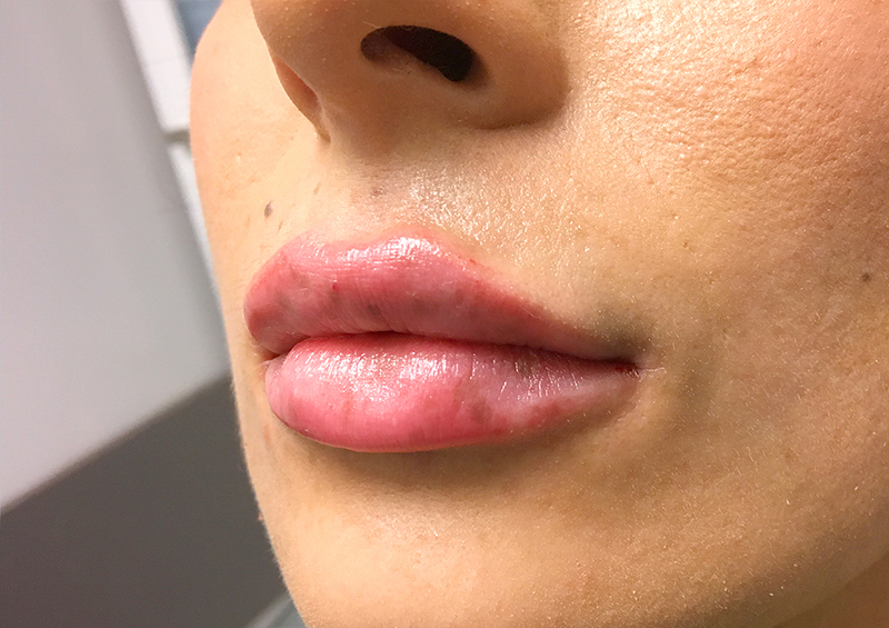 Injectables And Fillers 03