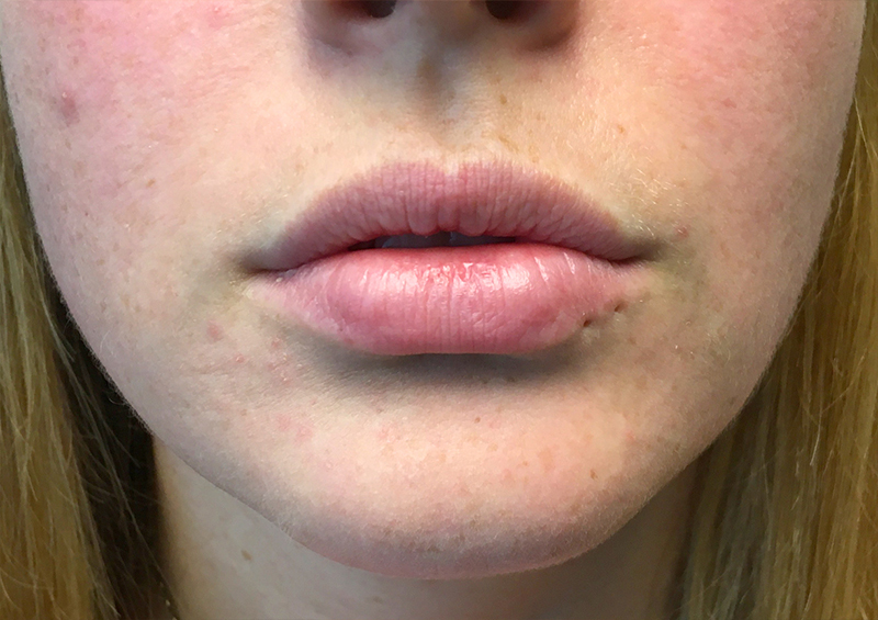 Injectables And Fillers 01