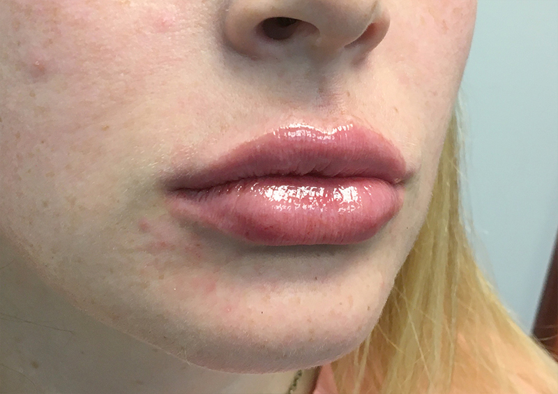 Injectables And Fillers 03