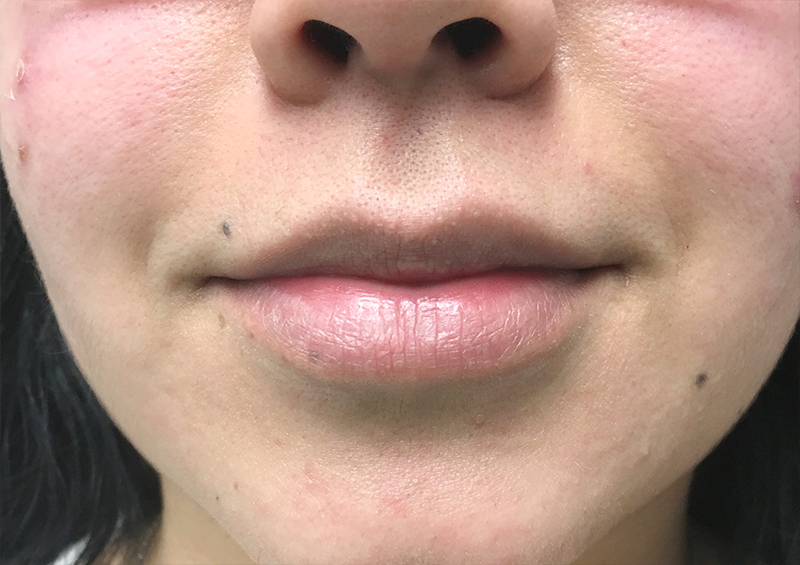 Injectables And Fillers 01