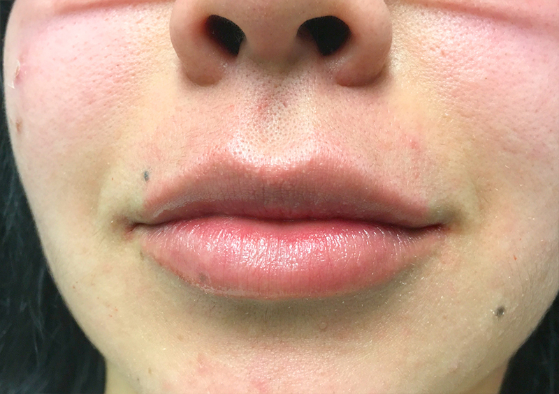 Injectables And Fillers 132