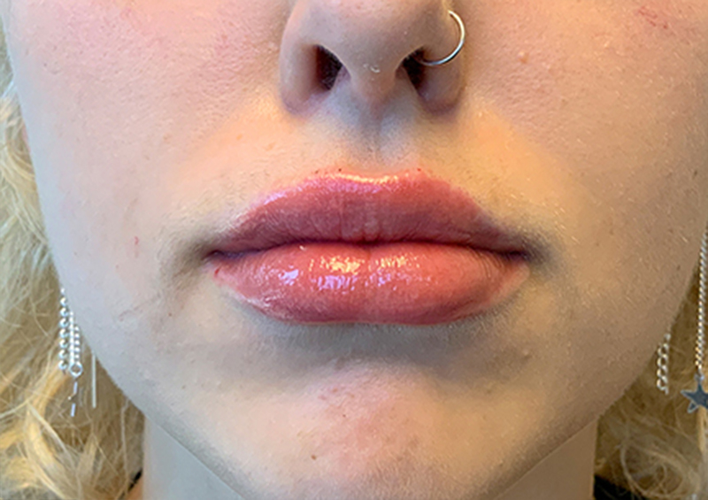 Injectables And Fillers 134