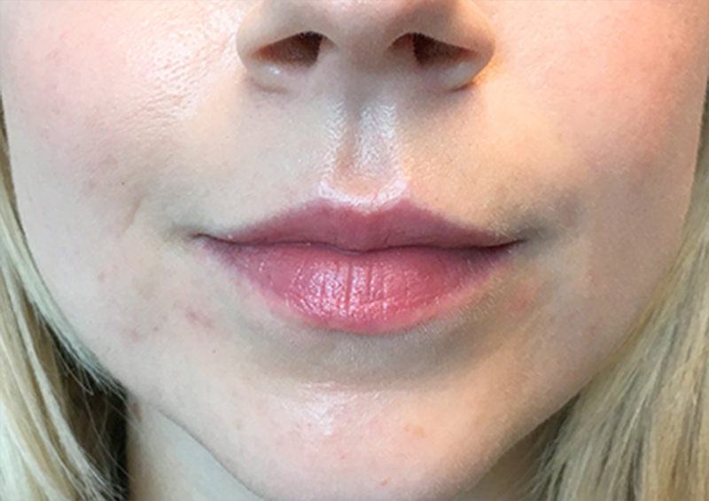 Injectables And Fillers 01