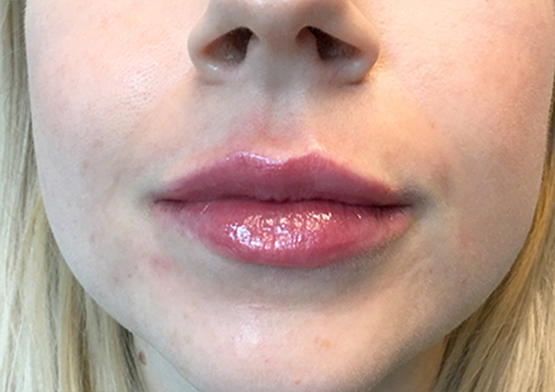 Injectables And Fillers 135